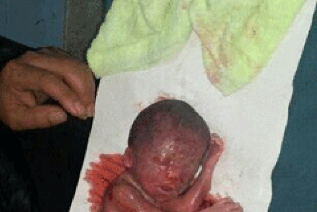 中國再暴計生血案 安徽7個月胎兒被強制流產