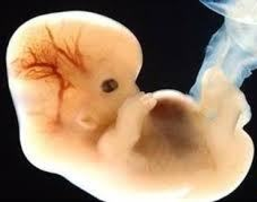 「自選性別」具爭議 先天雙性兒又如何﹖