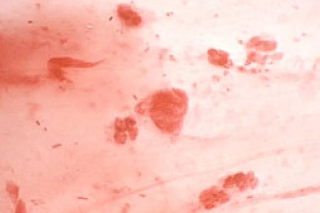 世衛組織：淋病超強耐藥性或成重大危機