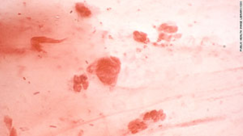 世衛組織:淋病超強耐藥性或成重大危機