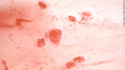 世衛組織:淋病超強耐藥性或成重大危機