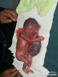 中國再暴計生血案 安徽7個月胎兒被強制流產