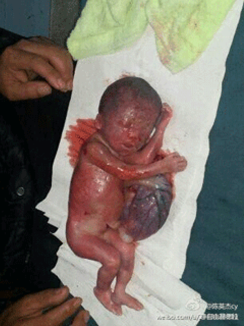 中國再暴計生血案 安徽7個月胎兒被強制流產